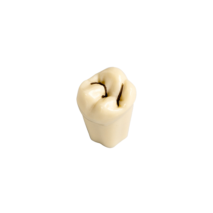 Diente Con Caries En Fisura No 17