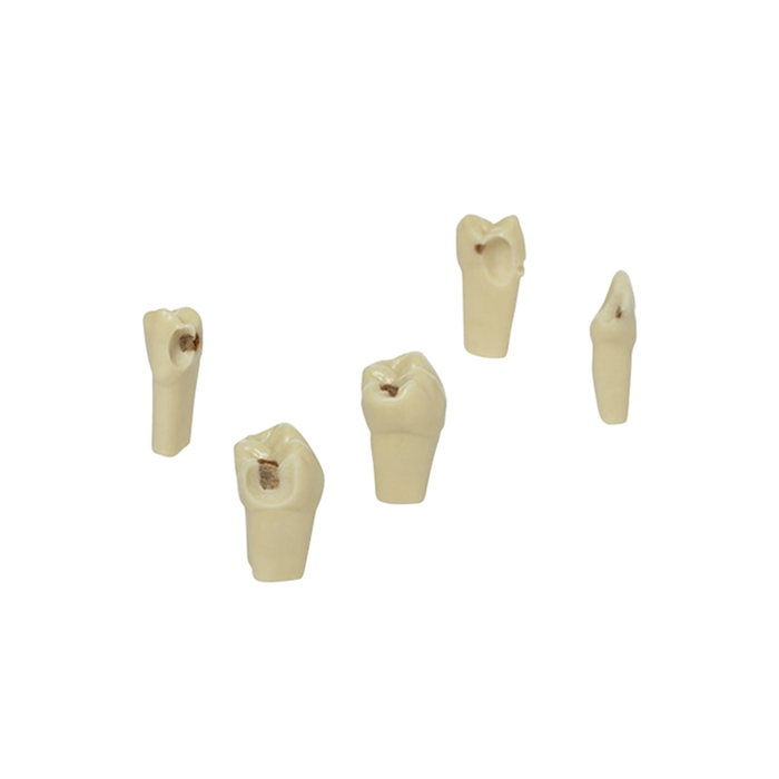 Diente Con Caries Socavada Reconocible En La Radiografía Dental